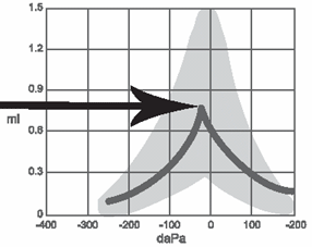Tympanogram showing maximum peak compliance within the normal range