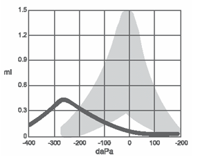 Type C tympanogram showing negative peak pressure